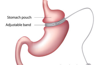 Understanding Adjustable Gastric Bands