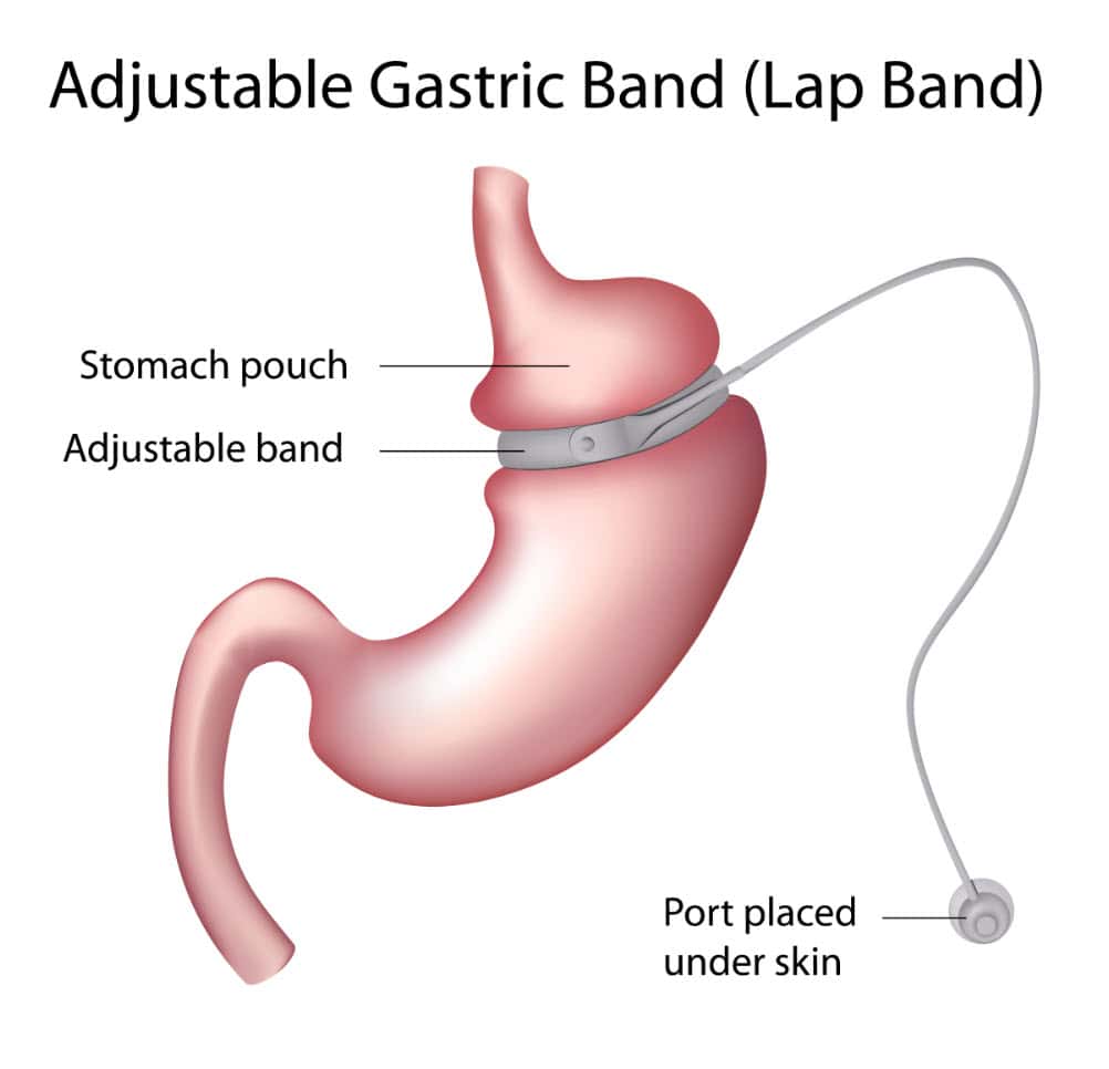 adjustable gastric band design